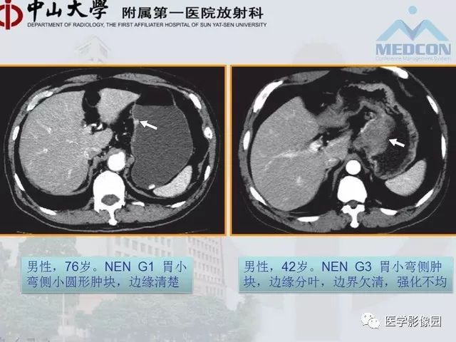 【PPT】胃肠胰神经内分泌肿瘤的病理与治疗后影像观察