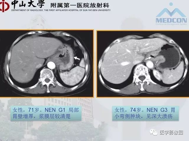 【PPT】胃肠胰神经内分泌肿瘤的病理与治疗后影像观察