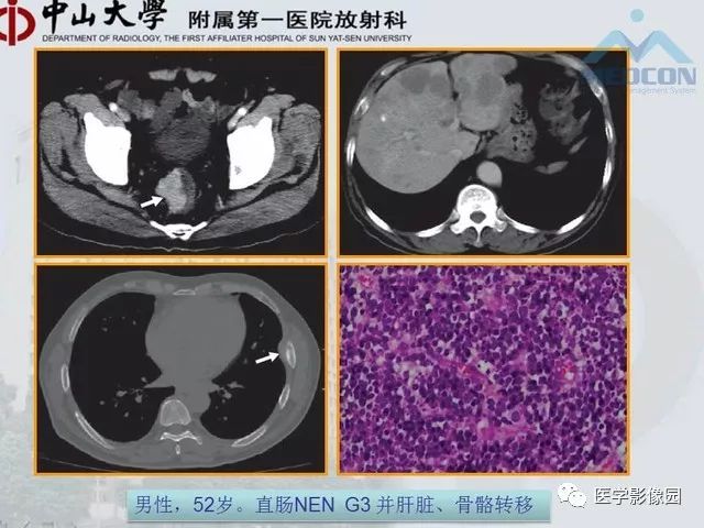 【PPT】胃肠胰神经内分泌肿瘤的病理与治疗后影像观察