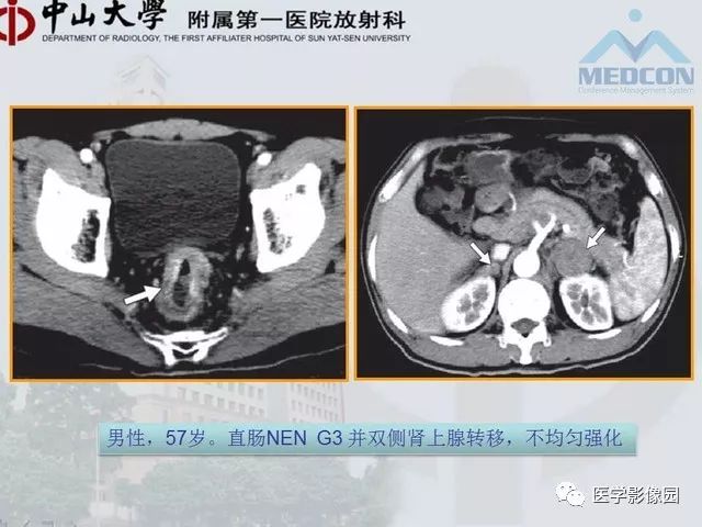 【PPT】胃肠胰神经内分泌肿瘤的病理与治疗后影像观察