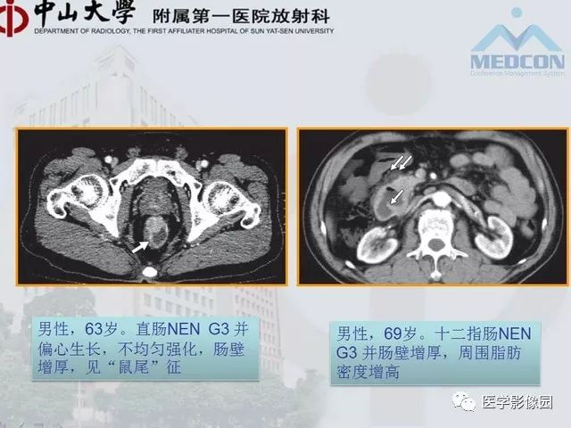 【PPT】胃肠胰神经内分泌肿瘤的病理与治疗后影像观察