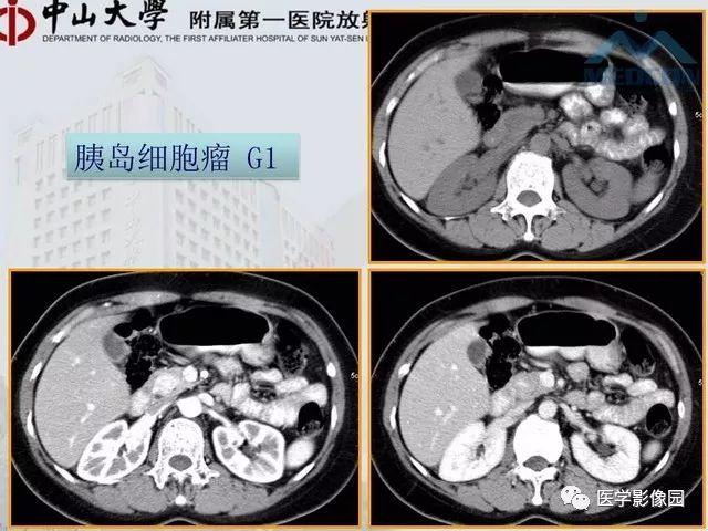 【PPT】胃肠胰神经内分泌肿瘤的病理与治疗后影像观察