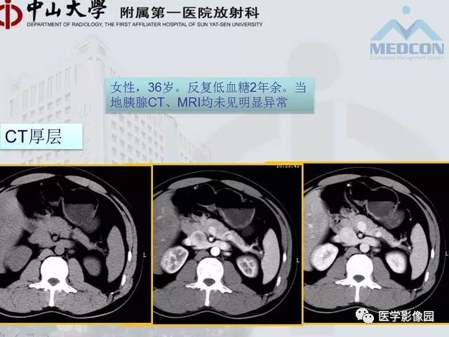【PPT】胃肠胰神经内分泌肿瘤的病理与治疗后影像观察