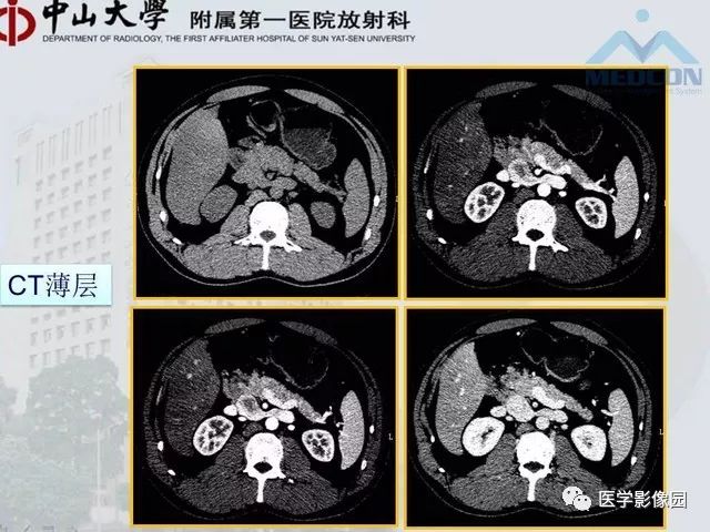【PPT】胃肠胰神经内分泌肿瘤的病理与治疗后影像观察