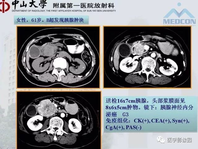 【PPT】胃肠胰神经内分泌肿瘤的病理与治疗后影像观察