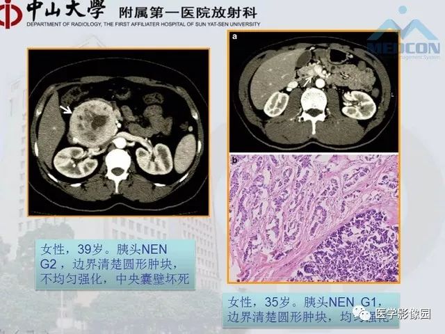 【PPT】胃肠胰神经内分泌肿瘤的病理与治疗后影像观察