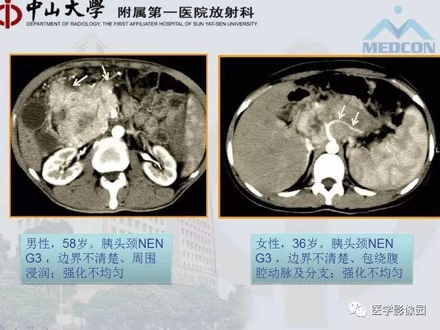 【PPT】胃肠胰神经内分泌肿瘤的病理与治疗后影像观察