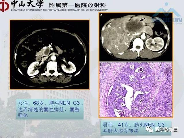 【PPT】胃肠胰神经内分泌肿瘤的病理与治疗后影像观察