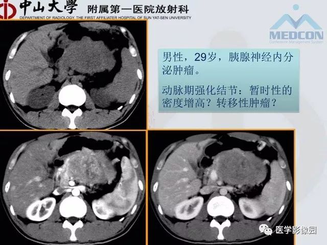 【PPT】胃肠胰神经内分泌肿瘤的病理与治疗后影像观察