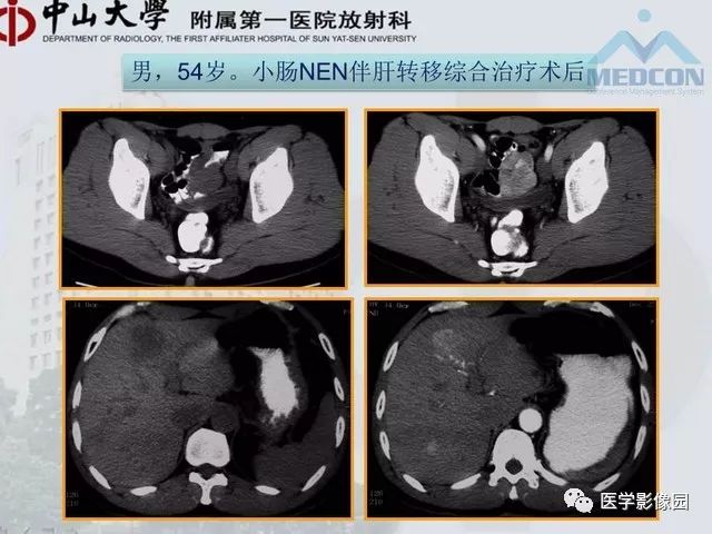【PPT】胃肠胰神经内分泌肿瘤的病理与治疗后影像观察