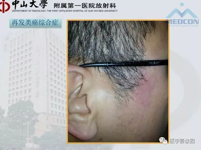 【PPT】胃肠胰神经内分泌肿瘤的病理与治疗后影像观察
