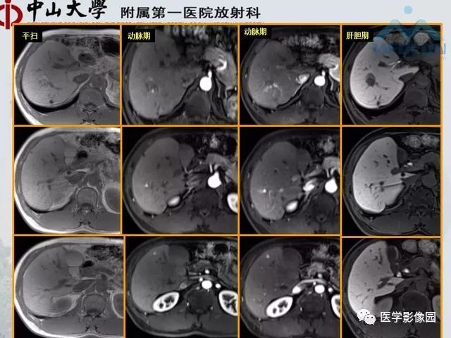 【PPT】胃肠胰神经内分泌肿瘤的病理与治疗后影像观察