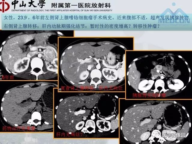 【PPT】胃肠胰神经内分泌肿瘤的病理与治疗后影像观察