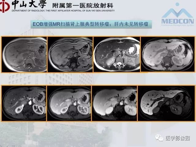 【PPT】胃肠胰神经内分泌肿瘤的病理与治疗后影像观察
