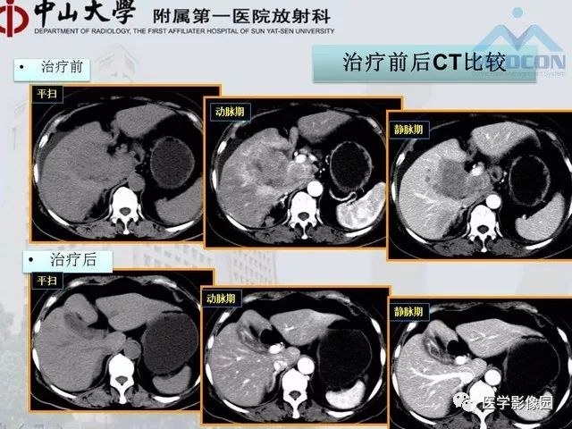 【PPT】胃肠胰神经内分泌肿瘤的病理与治疗后影像观察