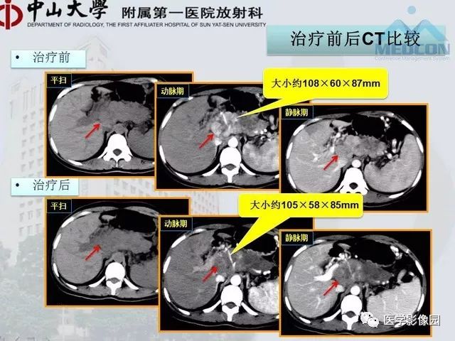 【PPT】胃肠胰神经内分泌肿瘤的病理与治疗后影像观察
