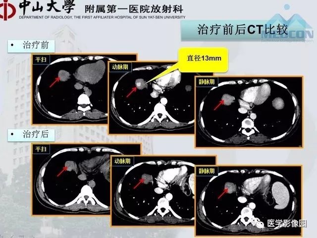 【PPT】胃肠胰神经内分泌肿瘤的病理与治疗后影像观察
