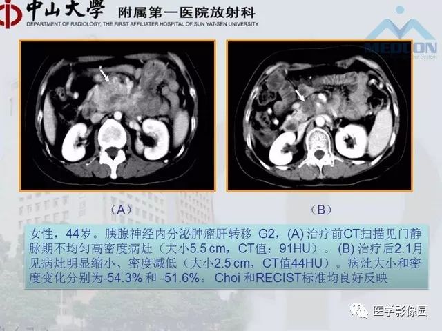 【PPT】胃肠胰神经内分泌肿瘤的病理与治疗后影像观察