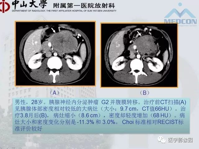 【PPT】胃肠胰神经内分泌肿瘤的病理与治疗后影像观察