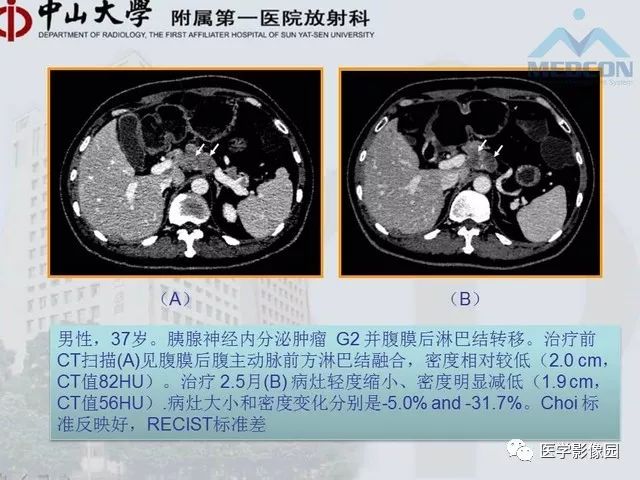 【PPT】胃肠胰神经内分泌肿瘤的病理与治疗后影像观察