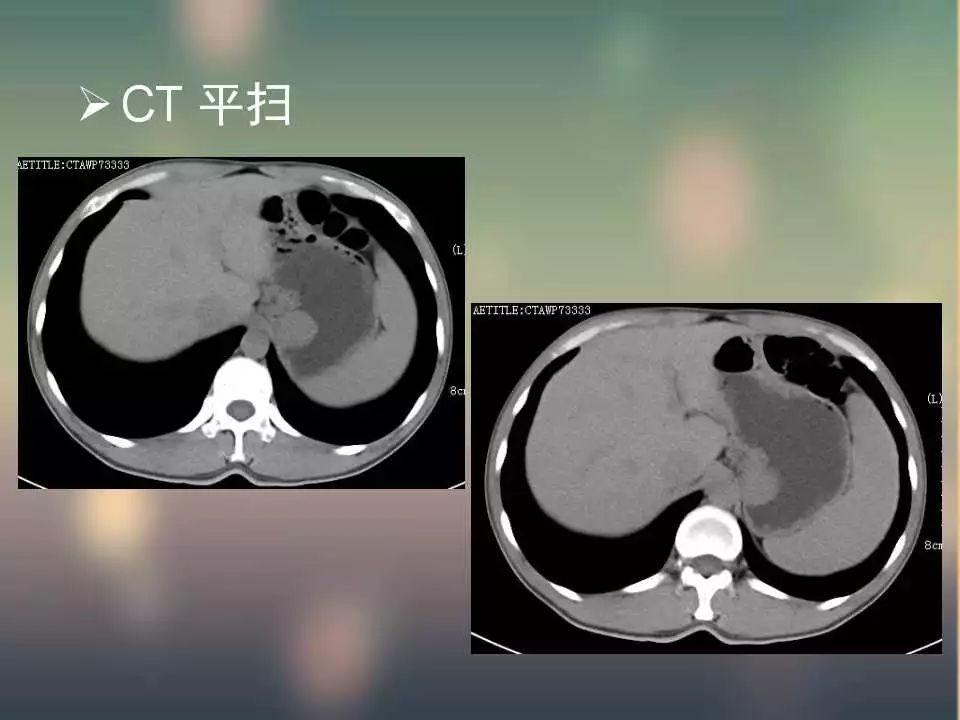 【PPT】(3例)胃部病变病例分析