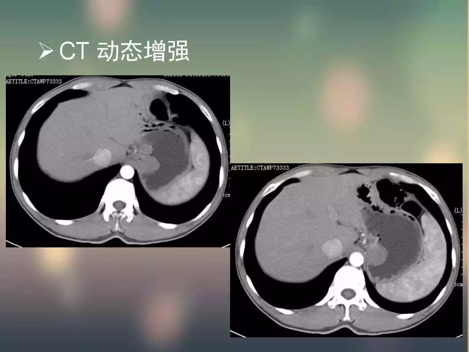【PPT】(3例)胃部病变病例分析