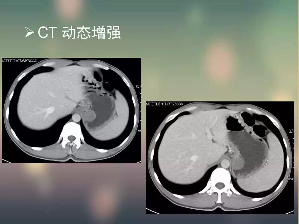 【PPT】(3例)胃部病变病例分析