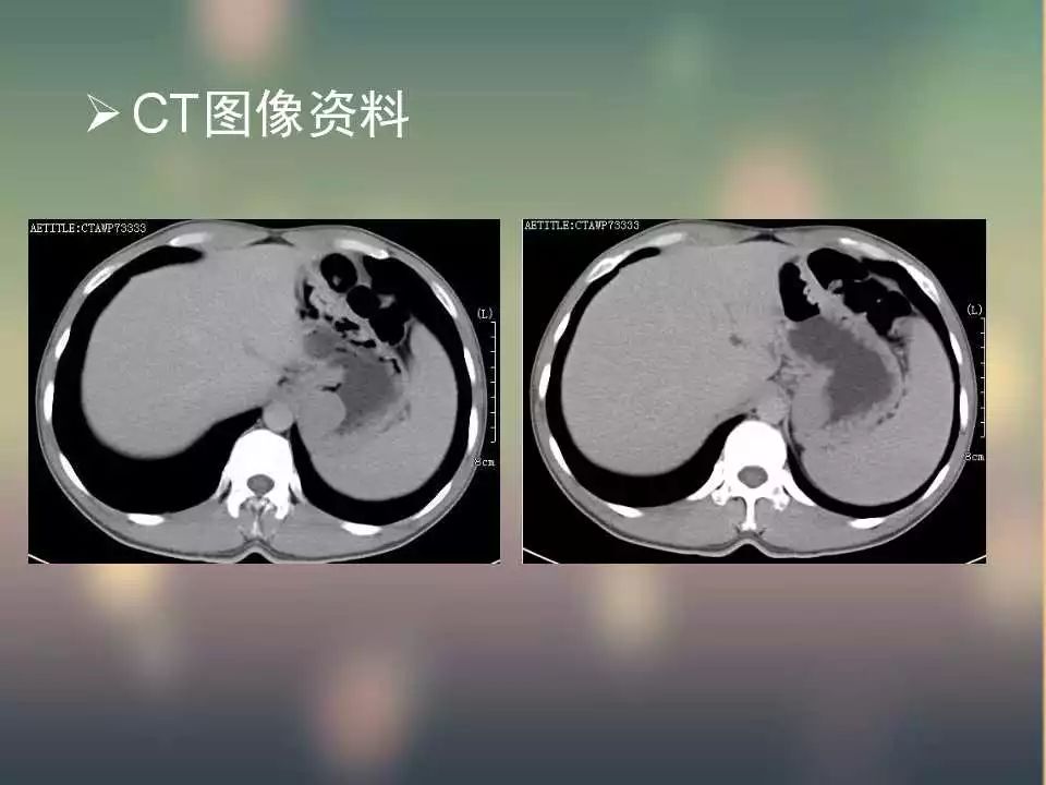 【PPT】(3例)胃部病变病例分析