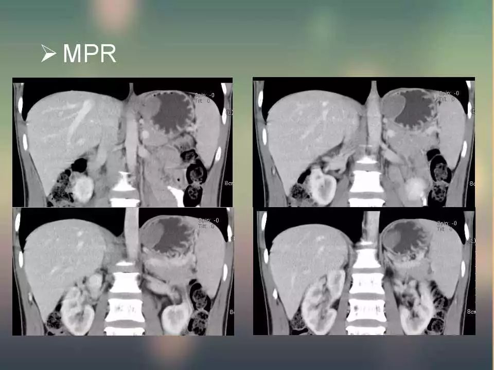 【PPT】(3例)胃部病变病例分析