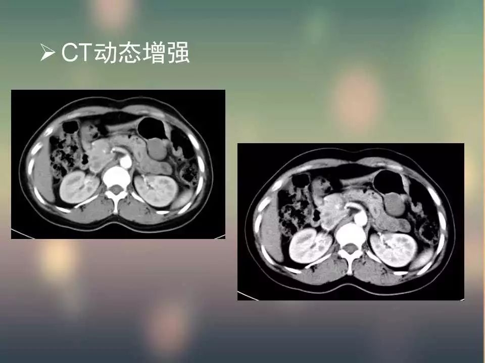 【PPT】(3例)胃部病变病例分析