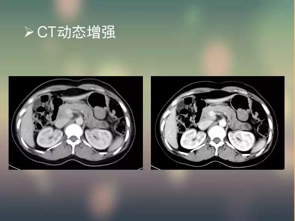 【PPT】(3例)胃部病变病例分析