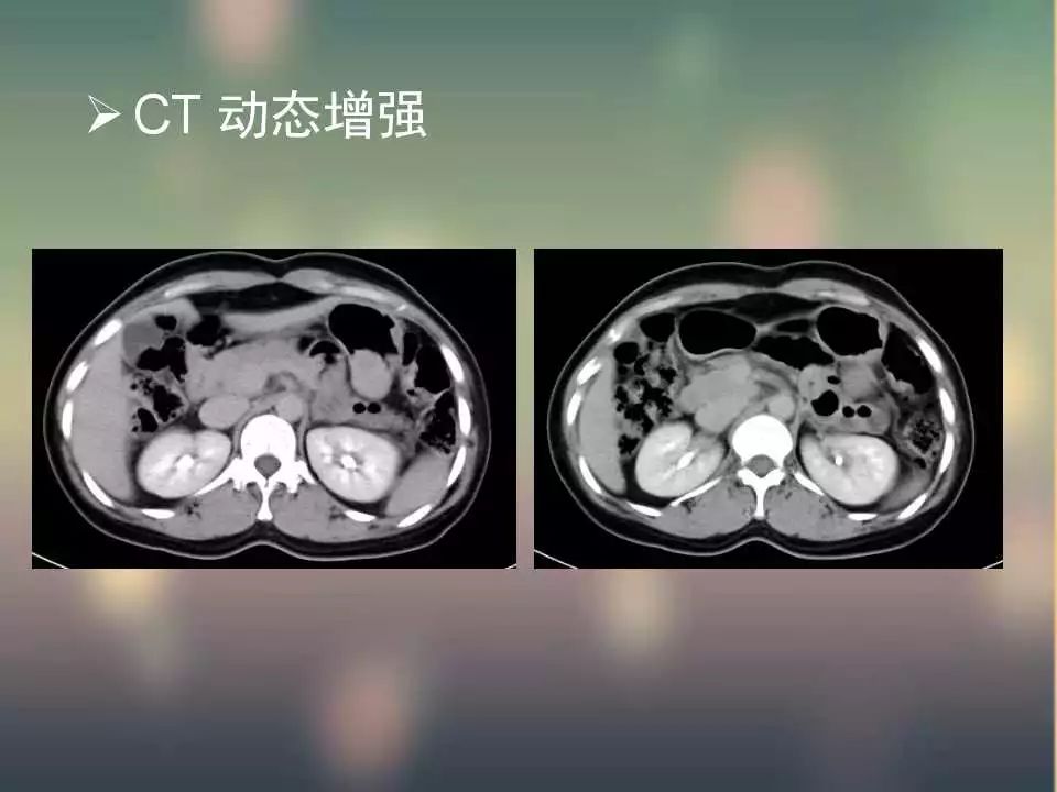 【PPT】(3例)胃部病变病例分析