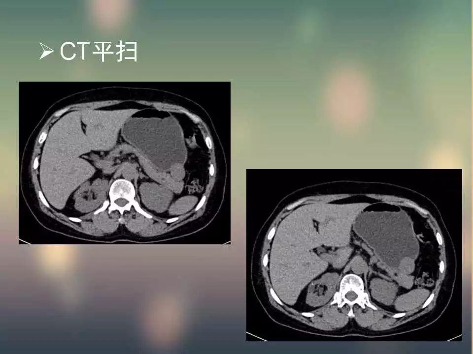 【PPT】(3例)胃部病变病例分析