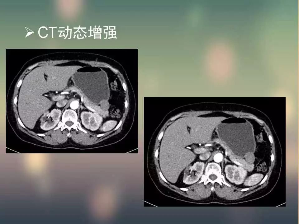 【PPT】(3例)胃部病变病例分析