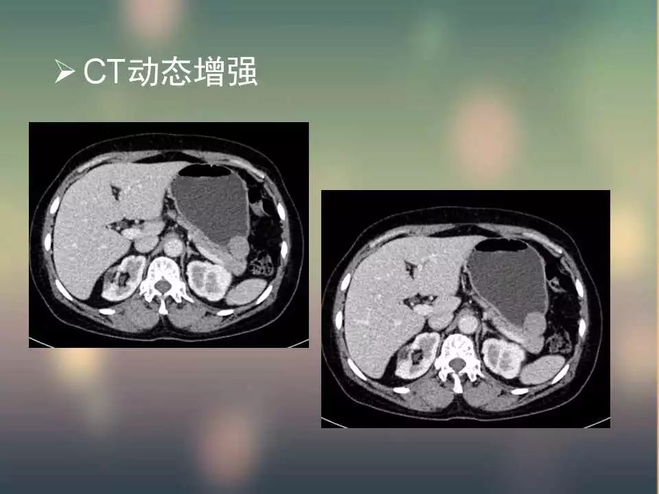 【PPT】(3例)胃部病变病例分析