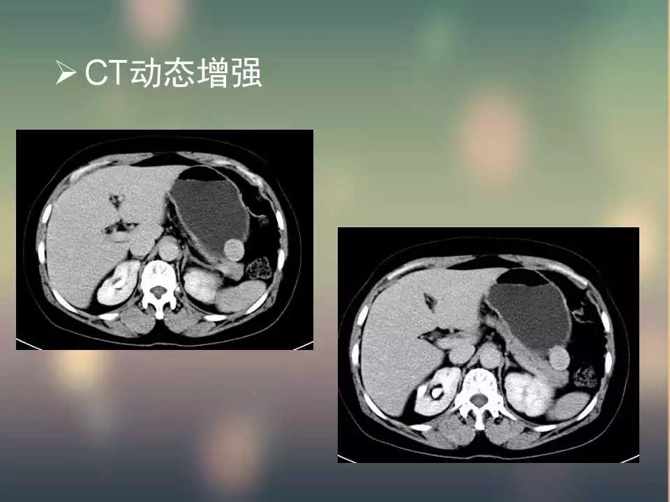 【PPT】(3例)胃部病变病例分析