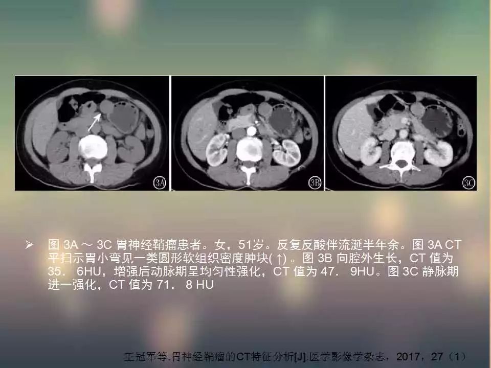 【PPT】(3例)胃部病变病例分析