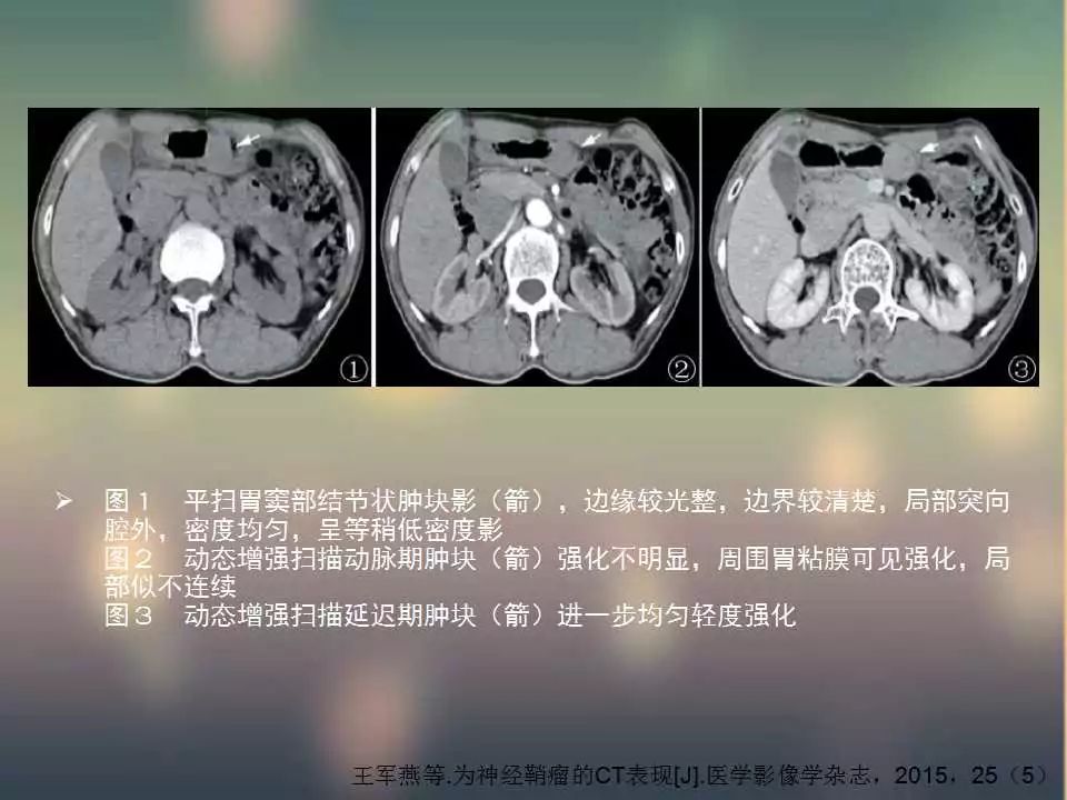 【PPT】(3例)胃部病变病例分析
