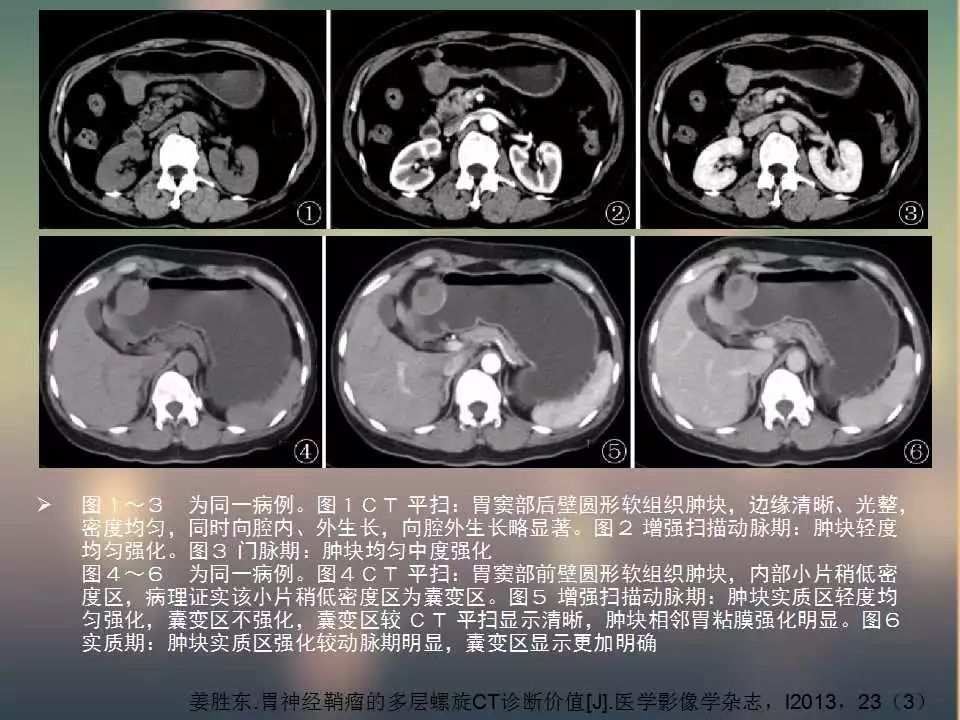 【PPT】(3例)胃部病变病例分析