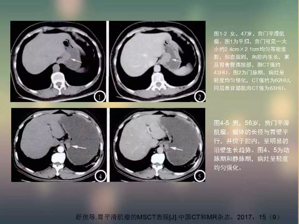 【PPT】(3例)胃部病变病例分析
