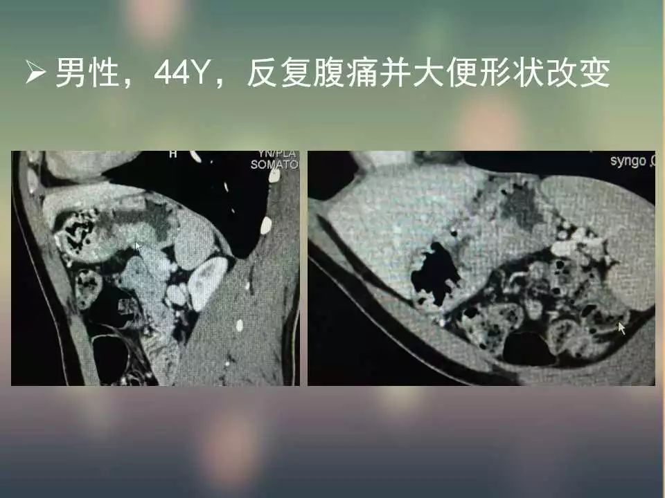 【PPT】(3例)胃部病变病例分析