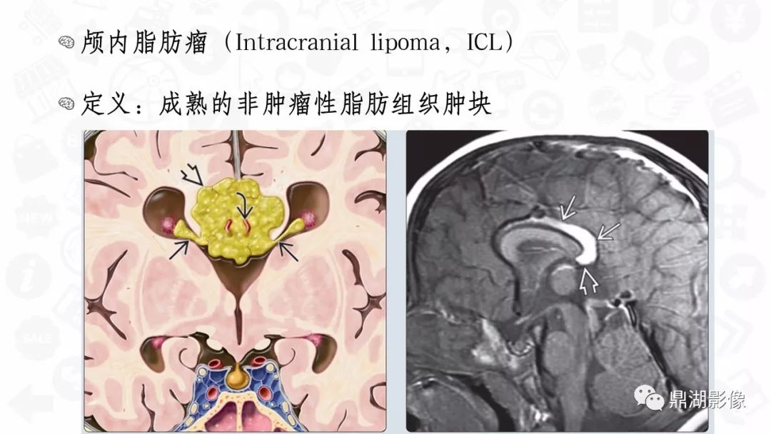 【PPT】颅内脂肪瘤影像诊断及鉴别诊断