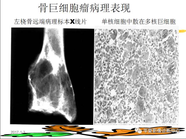 【PPT】骨巨细胞瘤的影像诊断及鉴别诊断