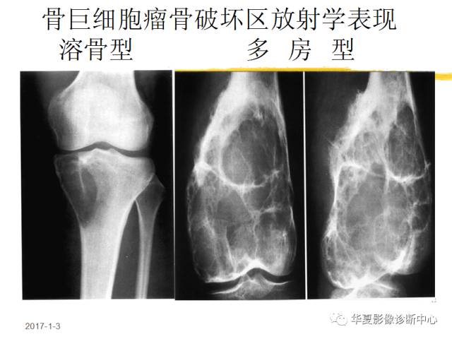 【PPT】骨巨细胞瘤的影像诊断及鉴别诊断