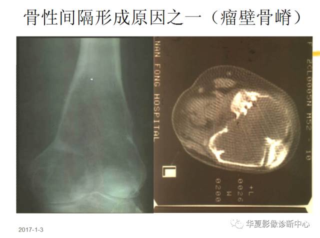 【PPT】骨巨细胞瘤的影像诊断及鉴别诊断