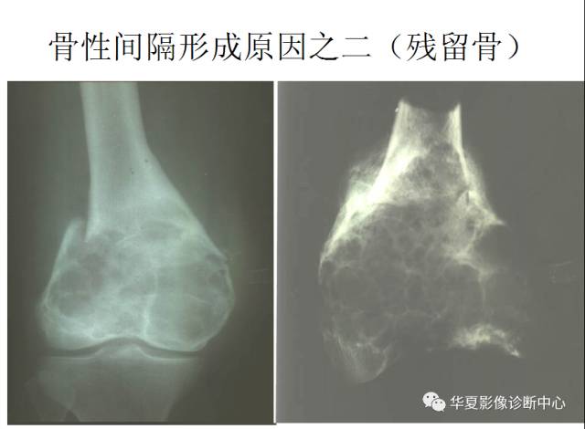 【PPT】骨巨细胞瘤的影像诊断及鉴别诊断
