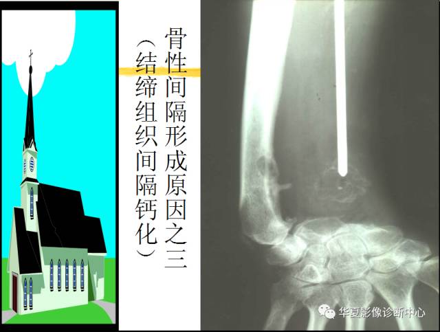【PPT】骨巨细胞瘤的影像诊断及鉴别诊断