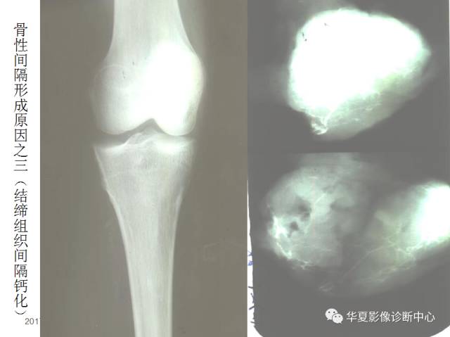 【PPT】骨巨细胞瘤的影像诊断及鉴别诊断