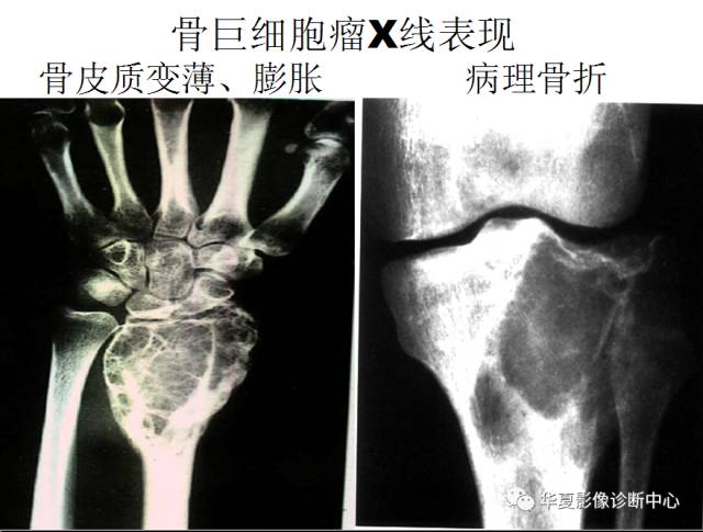 【PPT】骨巨细胞瘤的影像诊断及鉴别诊断