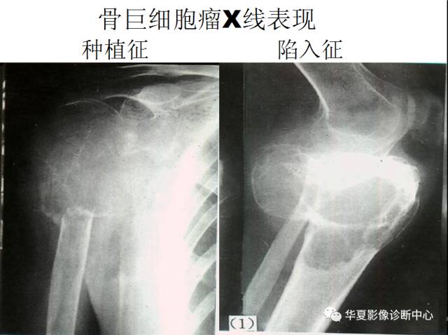 【PPT】骨巨细胞瘤的影像诊断及鉴别诊断